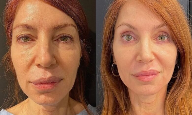 Upper Eyelid Blepharoplasty: The Small Procedure That Makes a Big Impact