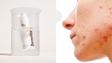 Treating Hormonal Acne