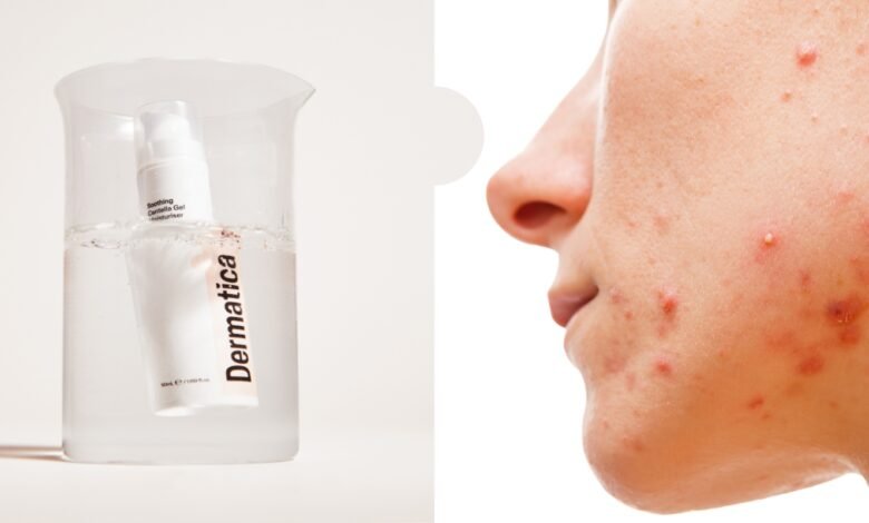 Treating Hormonal Acne